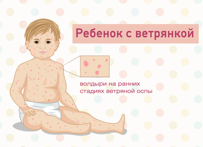 Как лечить ветрянку и чем она опасна: ТОП-5 основных правил